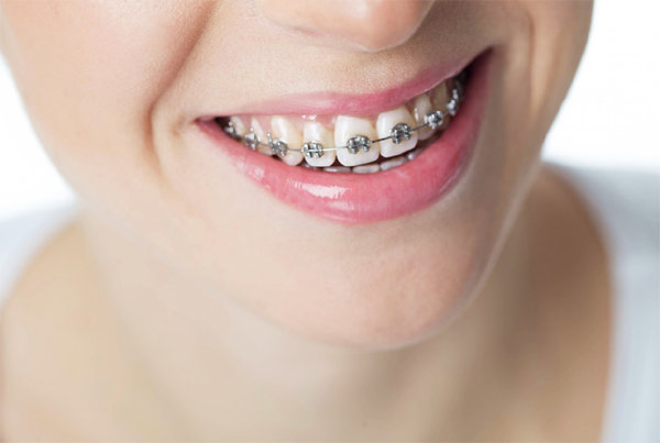 Dental Braces